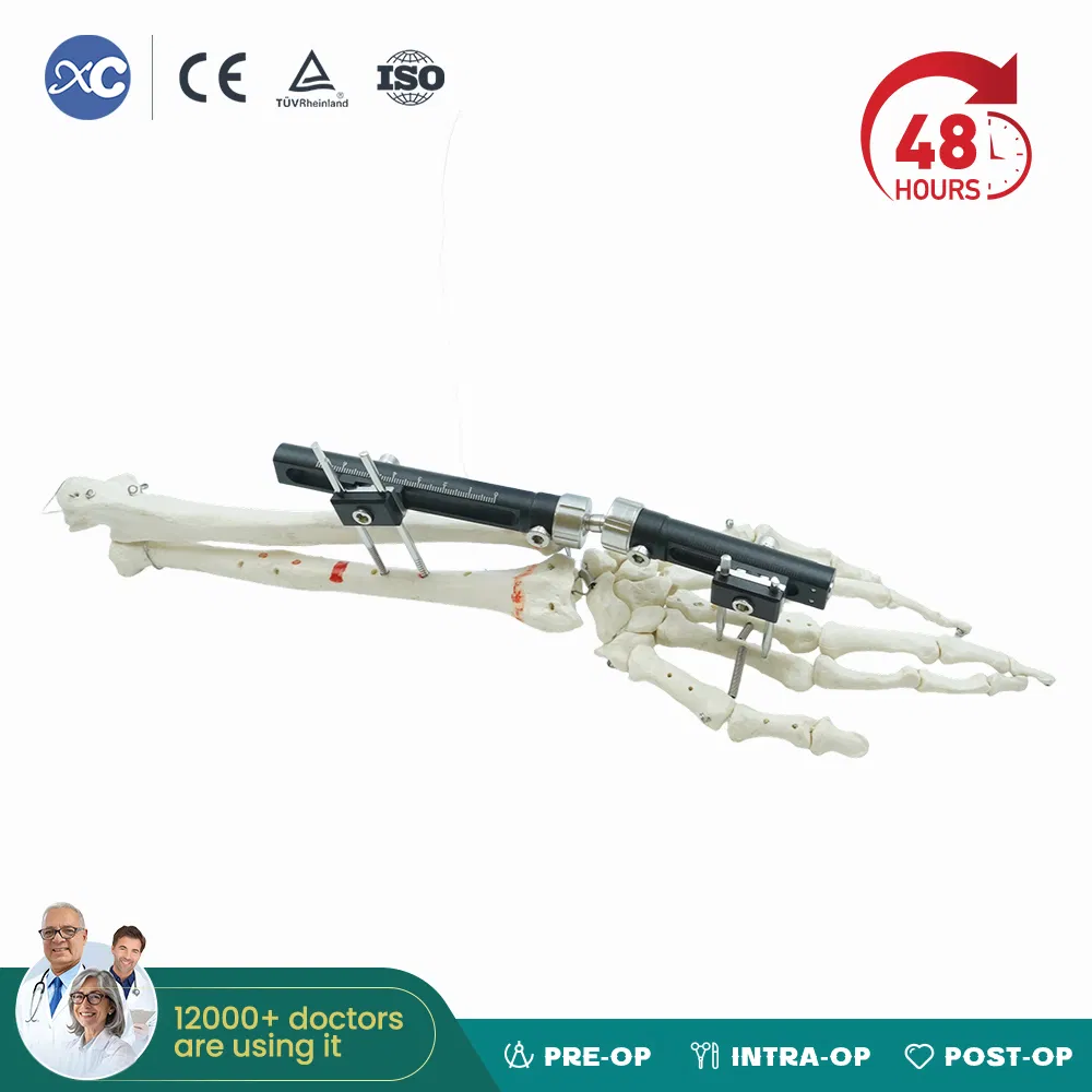 Factory Direct Supply Orthopaedic External Fixation Device, Ulna &amp; Radius External Fixator OEM ODM