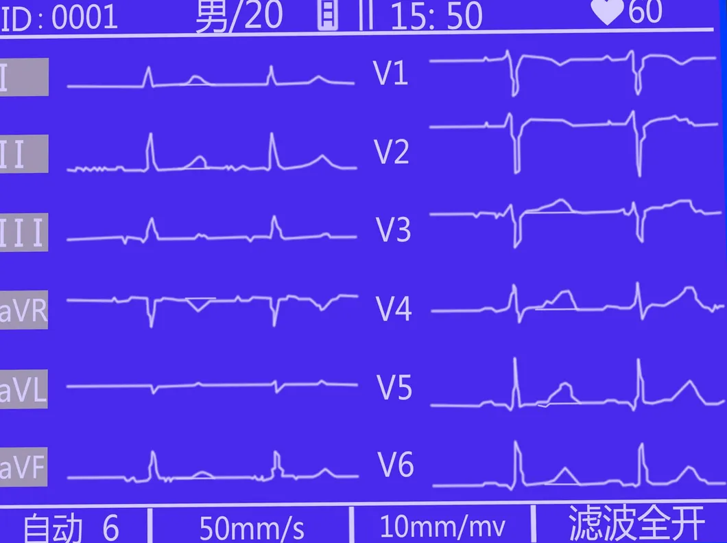 Detalle ECG 2