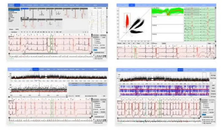 Análisis de Monitor Holter