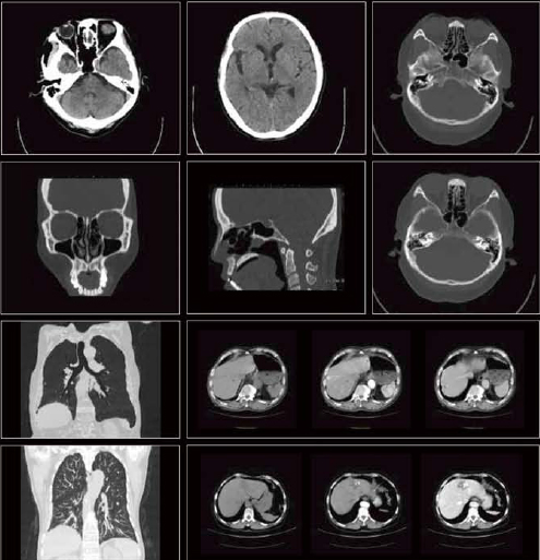 Immediately Shipping, Ce ISO Certification, Openmark 5000 0.5t MRI System