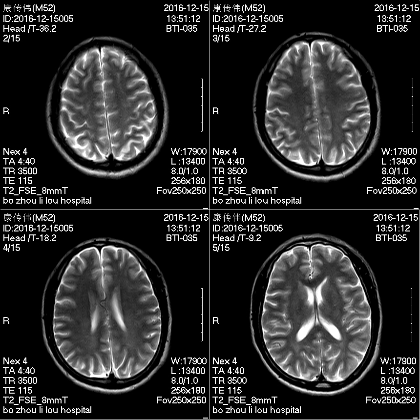 Immediately Shipping, Ce ISO Certification, Supermark 1.5t MRI System