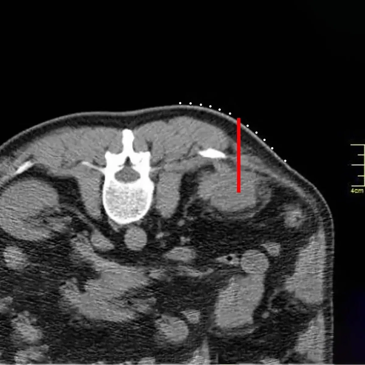 High-Precision Sterile CT Biopsy Grid for Interventional Procedures