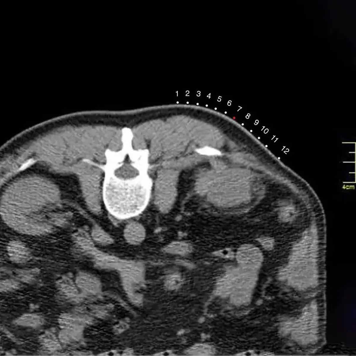 Disposable Medical Radiolucent CT Biopsy Grid for Accurate Needle Guidance