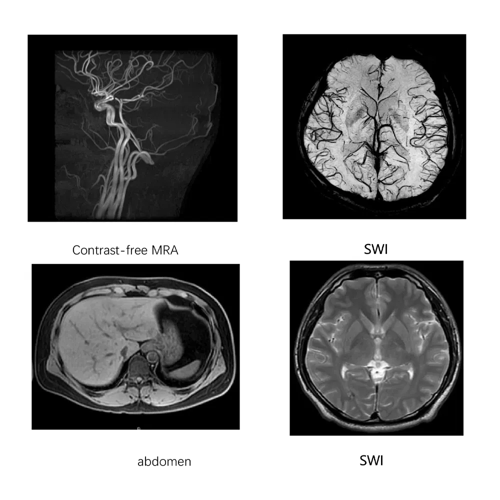 My-D054K Liquid Helium Free 1.5t MRI System