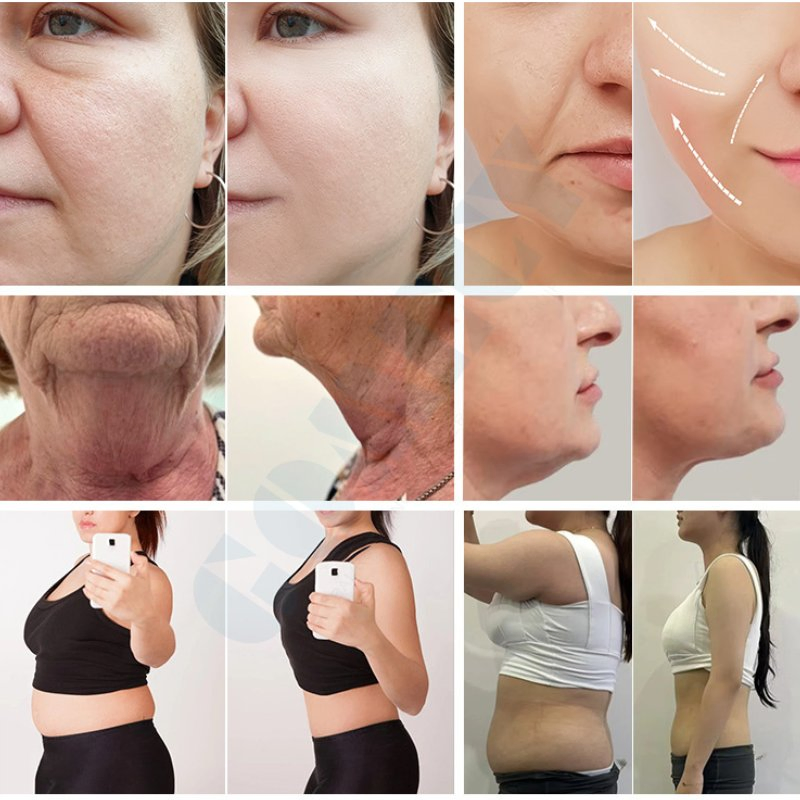 Non Invasive Cold Wave Body Contouring Machine for Professional Slimming Clinics