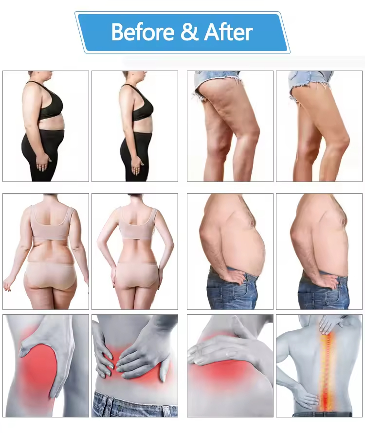 532nm Emerald Laser 10 D Low Level Cellulite Reduction Laser Therapy Device