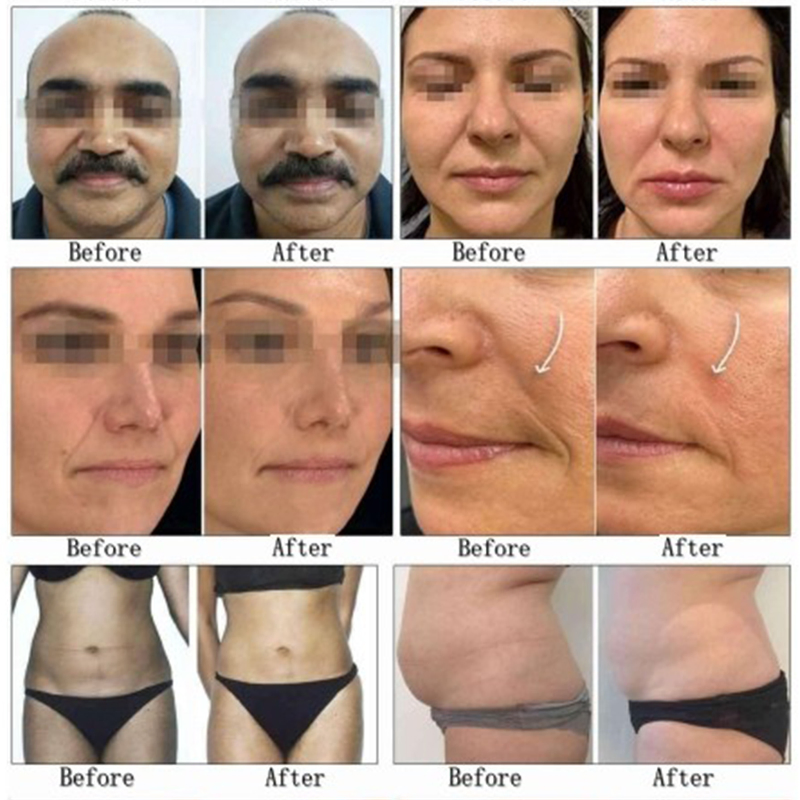 Hifu 12D Cryo Max Hifu High Intensity Focused Ultrasound Anti-Aging Technology Wrinkle Removal Device