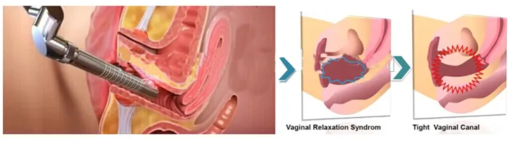 Vaginal Principle