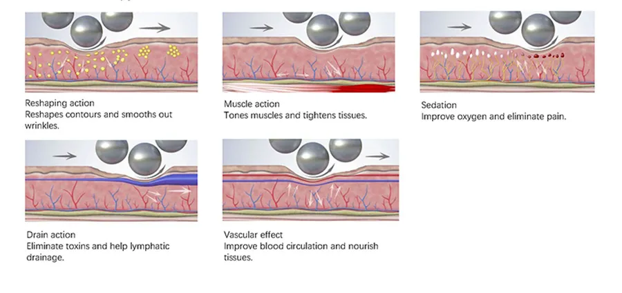 Endosphere Therapy Machine 2