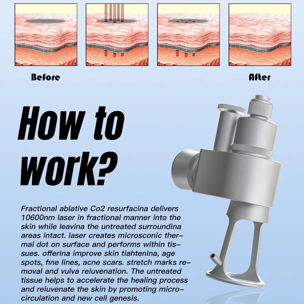 CO2 Fractional Machine RF Technology for Beauty Vaginal Rejuvenation &amp; Scar Removal