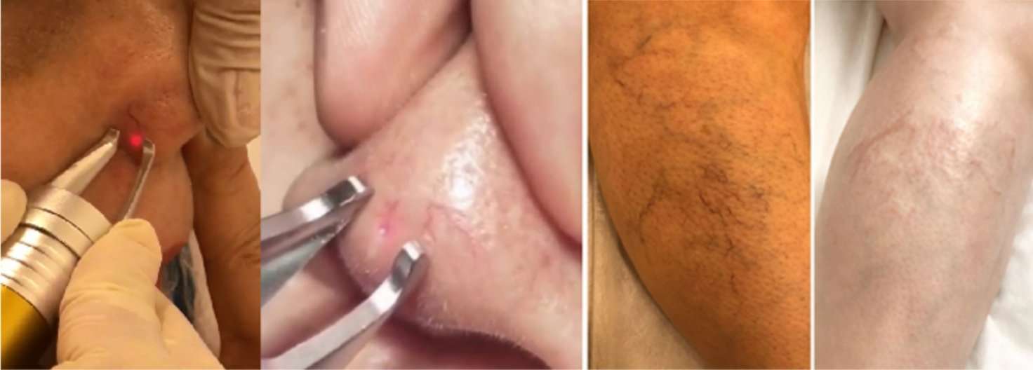 2024 Hot Selling 980nm Diode Laser Vascular Removal Spider Vein Removal Nail Fungus Removal Red Blood Treatment Instrument 980nm Laser