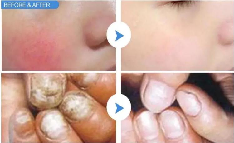 Factory Prices 980nm Diode Laser Vascular Therapy Machine Spider Veins Removal Skin Rejuvenation Laser Nail Fungus Therapy Device