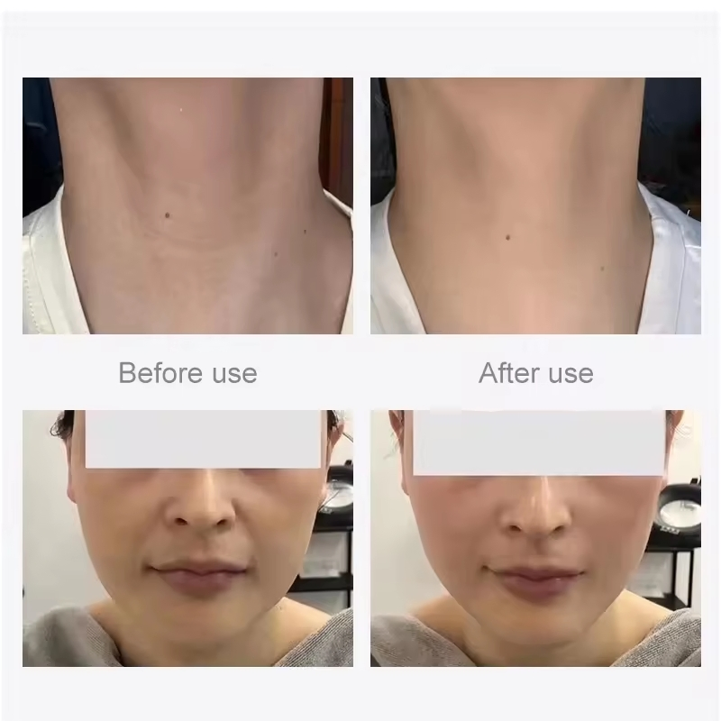 Latest Hifu 22D Max RF Lipo 18 Line Face Lifting Body Slimming High Intensity Focused Ultrasound