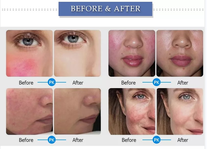 30% off Professional Capillary Removal Machine 980nm Diode Laser Vascular Removal Pink Spiders Vein Removal