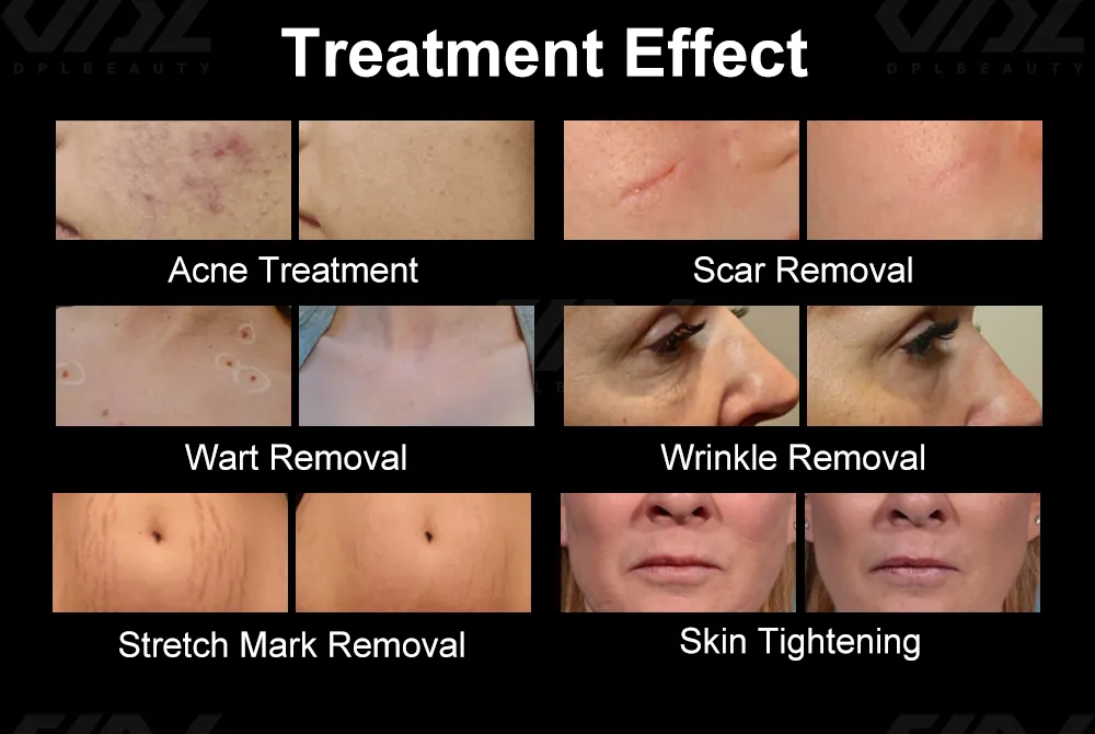 Laser Treatment Heads