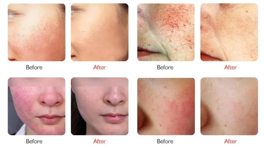 Application Treatment