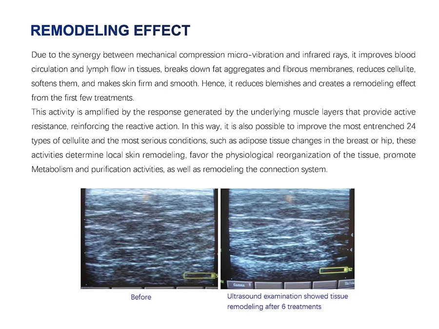 Endosphere Therapy Machine 7