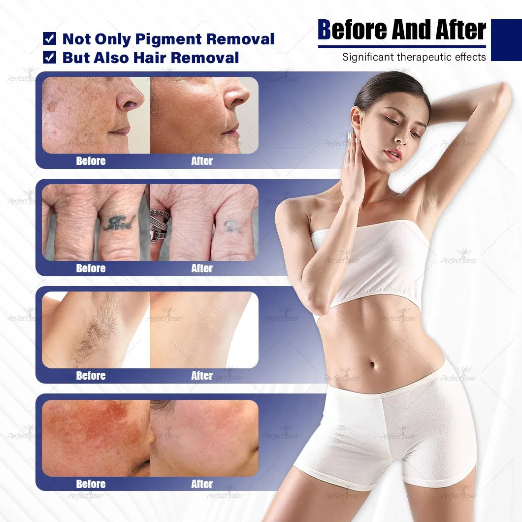 OEM ODM 3000W 4 Wavelength 532nm 755nm 1064nm 1320nm Tattoo Removal Machine Picosecond Laser Price