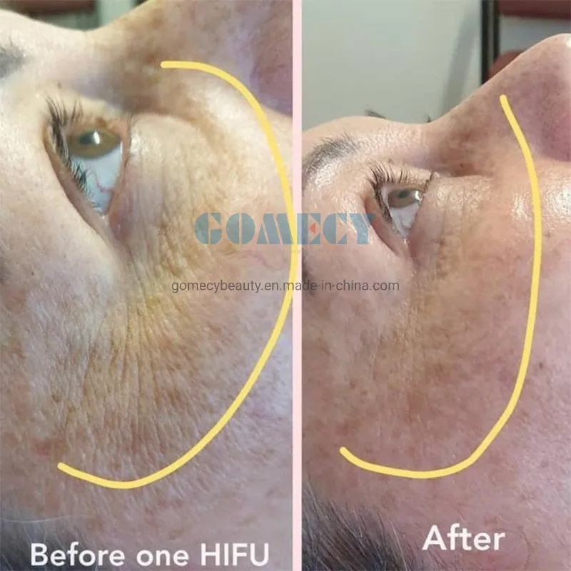 HIFU Treatment Before and After