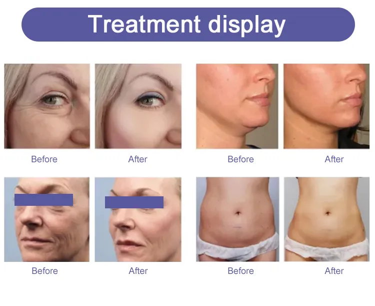 HIFU Cartridge View 2