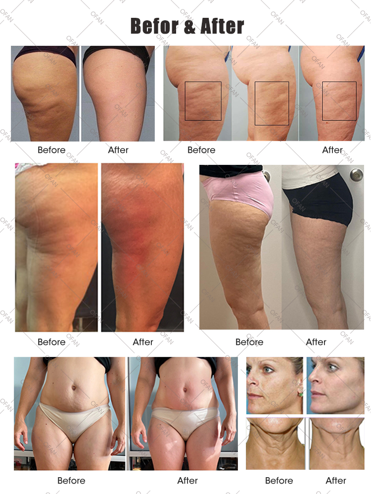 Ofan Cellulite Reduction Body Contouring Lymphatic Drainage Inner Ball Roller Endosphere Therapy Machine