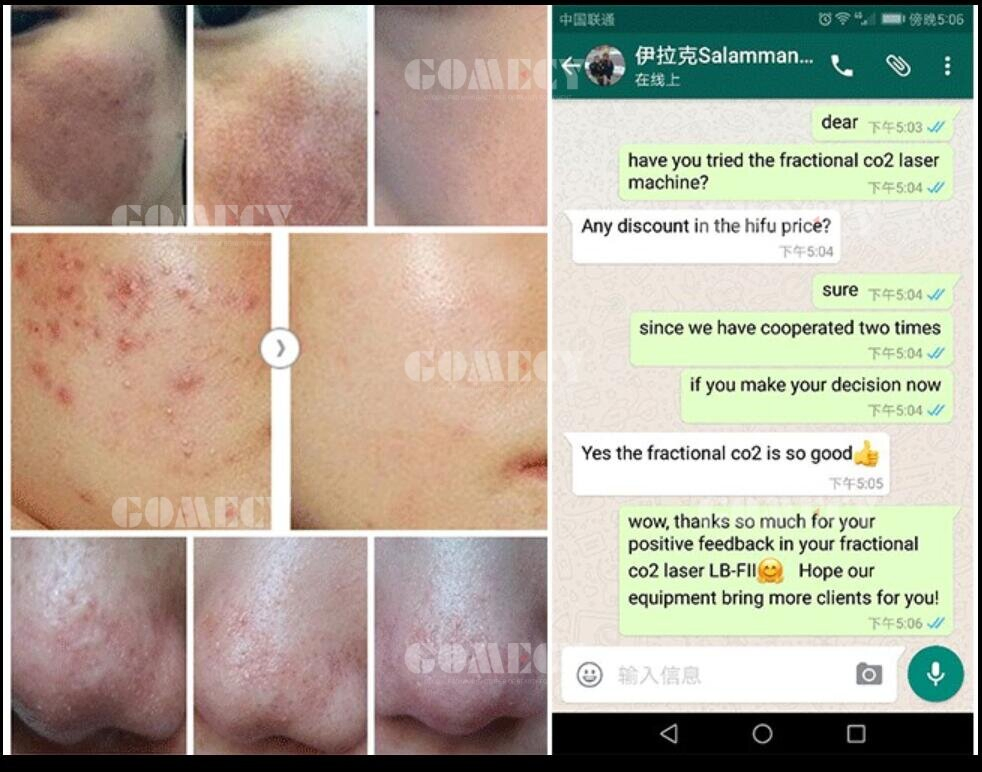 China Medical CE Approved Scar Removal Vaginal Tightening 10600nm Laser CO2 Fractional Laser Skin Resurfacing Machine