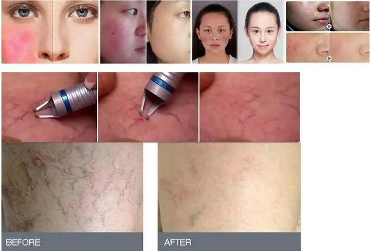 Laser Machine Treatment