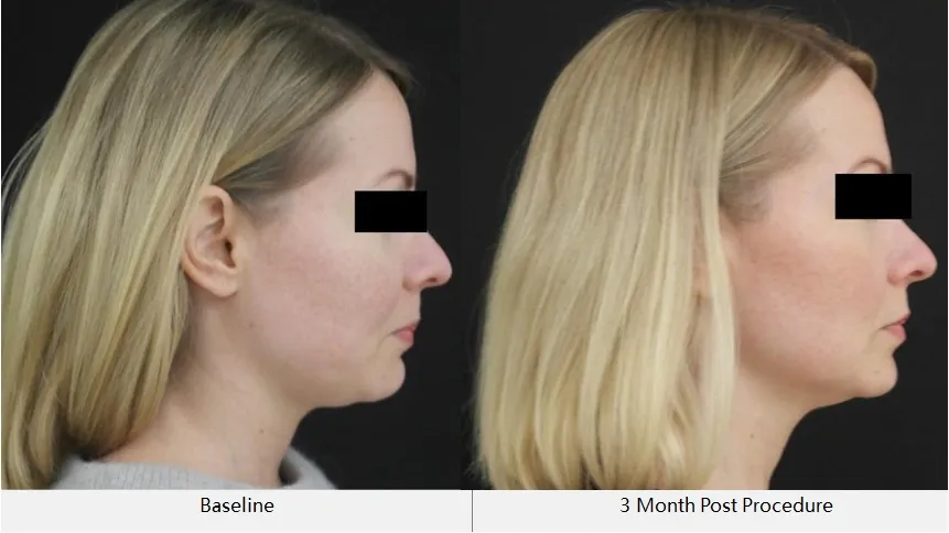 Skin Tightening Effect