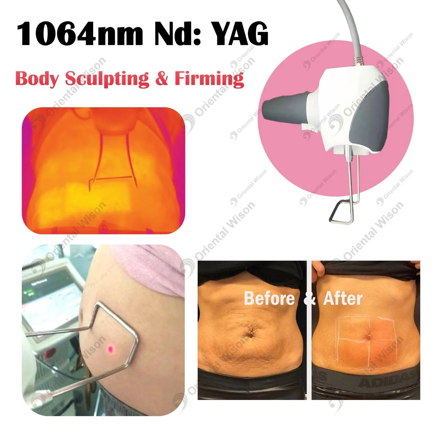 The Most Popular Fractional Skin Resurfacing Smooth Technology for Non-Surgical Vaginal Rejuvenation and Wellness Collagen Stimulation Multi-Layer Treatment