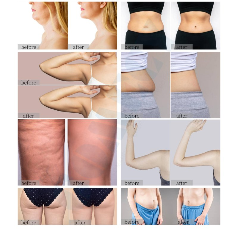 Cold Wave Non Invasive Body Contouring Equipment for Professional Beauty Use
