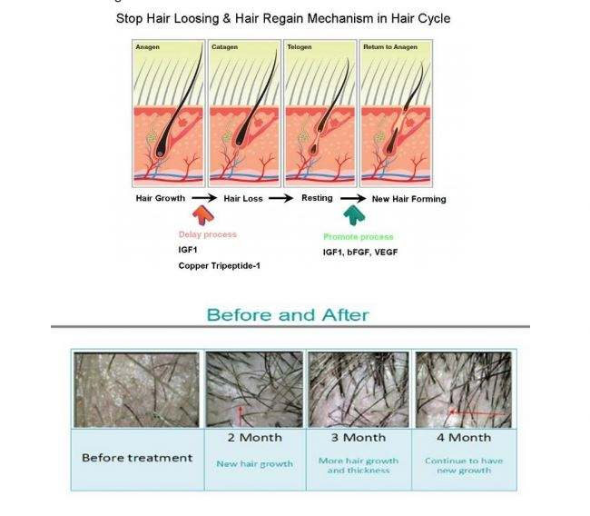 Diode Hair Growth Hatt Helmet Laser Hat Removal Machine Skin Analysis Scalp Analyzer Care Dropshipping Sample Loss Treatment