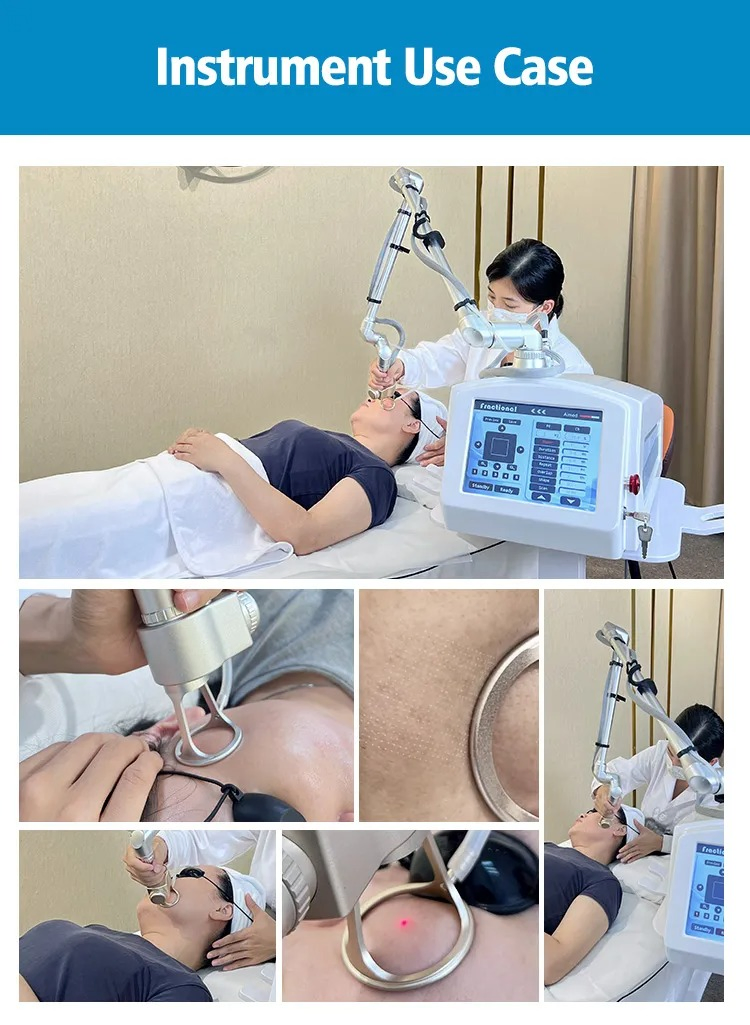 High Power 30W CO2 Laser CO2 Therapy Fractional Laser Skin Resurfacing Stretch Mark Treatment