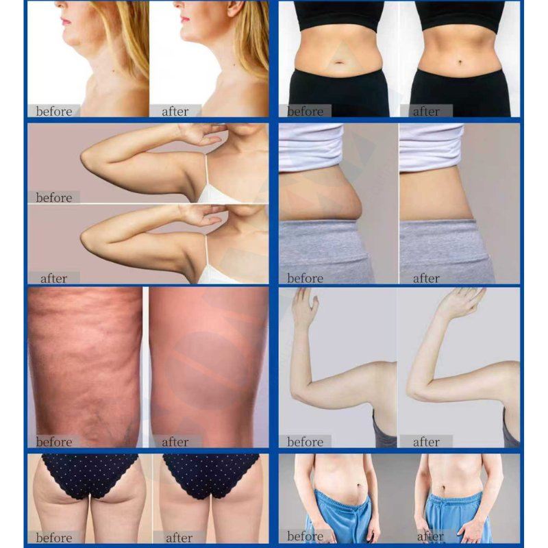 Cold Wave Microwave Body Contouring Machine for Non Invasive Fat Reduction Treatment