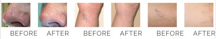 Vascular Removal Before After