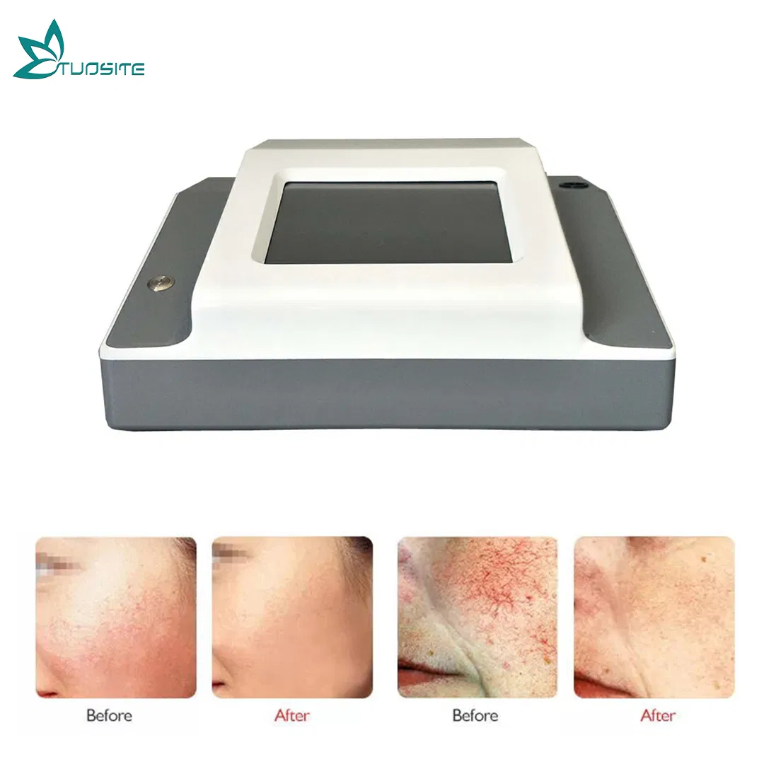 Laser Diode 980nm Laser Vascular Removal for Aesthetic Center Use
