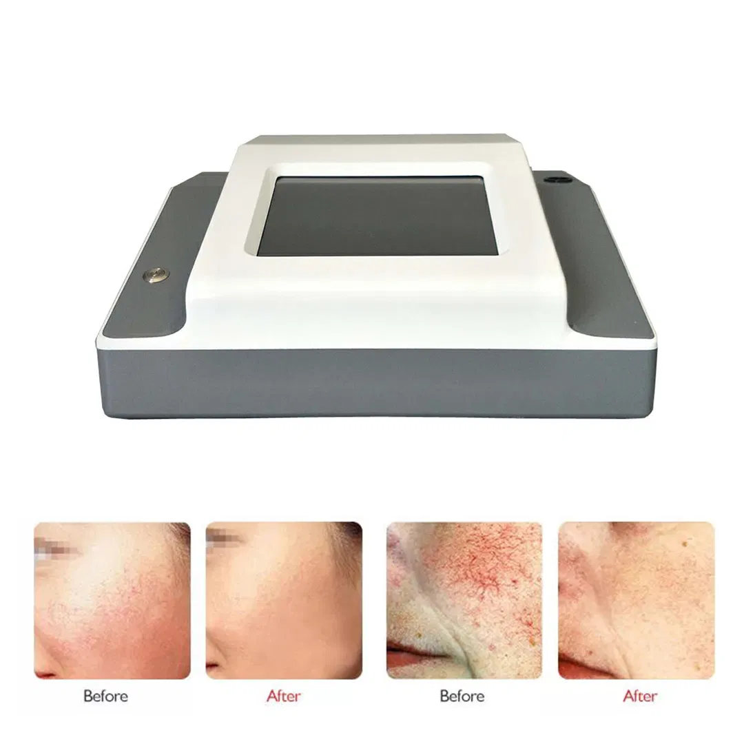 Laser Diode 980nm Laser Vascular Removal for Aesthetic Center Use
