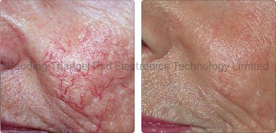 980nm Diode Laser Vascular Lesion Therapy Machine Removal Vascular