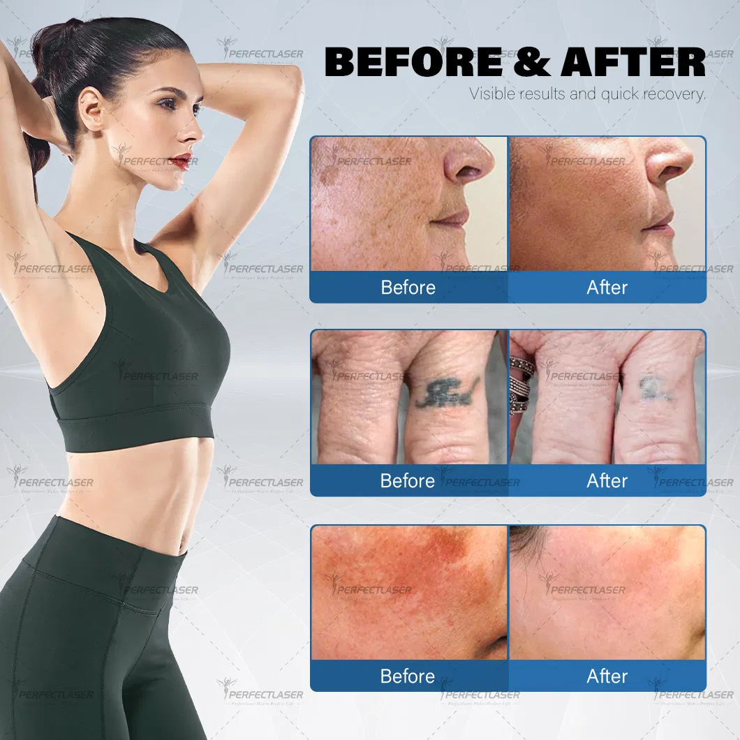Tattoo Removal Before and After