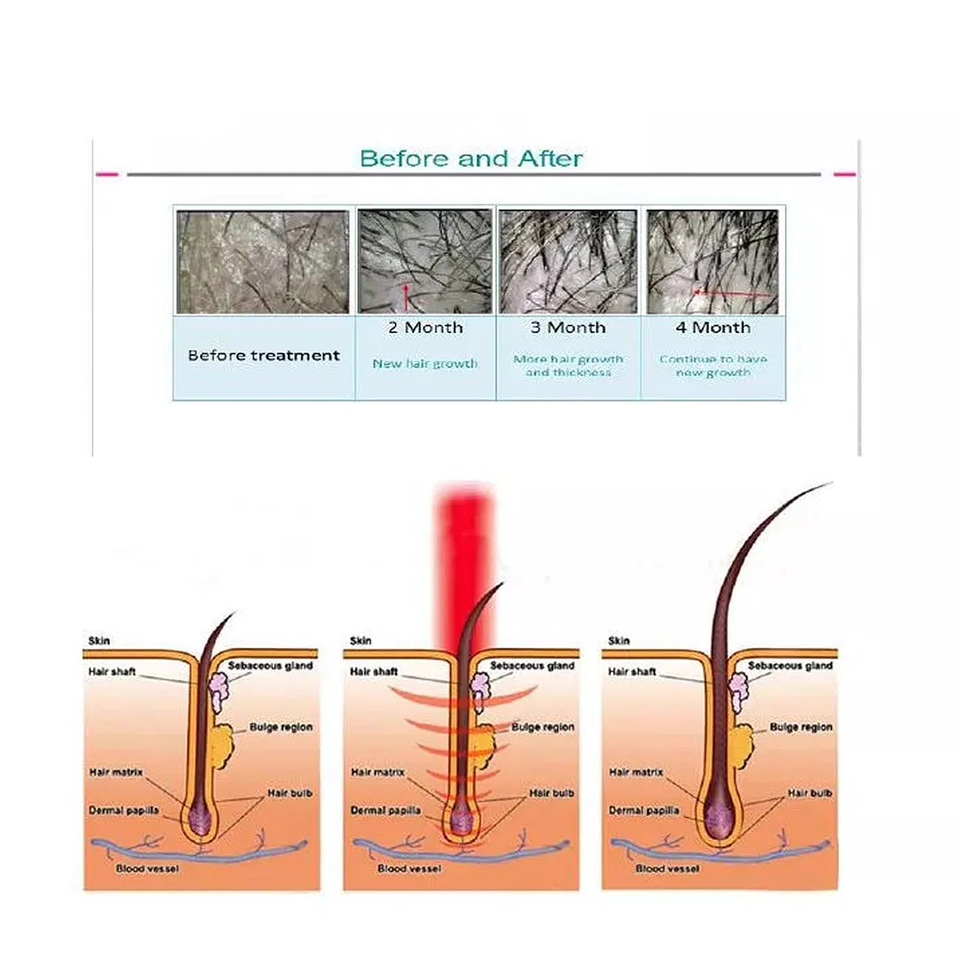 Professional Anti Hair Loss Treatment Diode Laser Hair Regrowth Machine