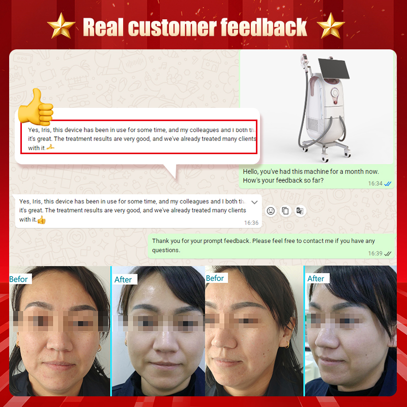 2026 IPL Bbl Photofacial Nir Skin Rejuvenation Laser Hair Removal Machine