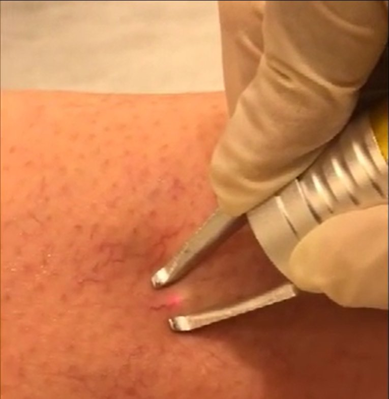 2024 Hot Selling 980nm Diode Laser Vascular Removal Spider Vein Removal Nail Fungus Removal Red Blood Treatment Instrument 980nm Laser