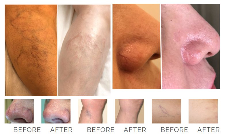 30W 60W Medical Spider Vascular Varicose Vein Removal Machine Vascular 980 Nm Laser