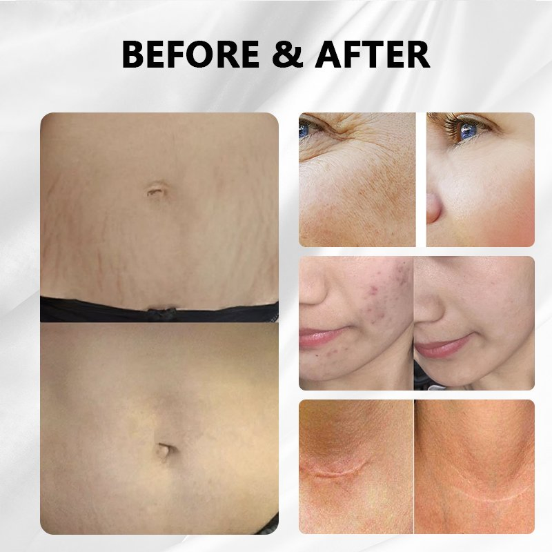 4D CO2 Laser Beauty Equipment Acne Scar Removal Skin Rejuvenation Vaginal Tightening Fractional CO2 Laser Machine