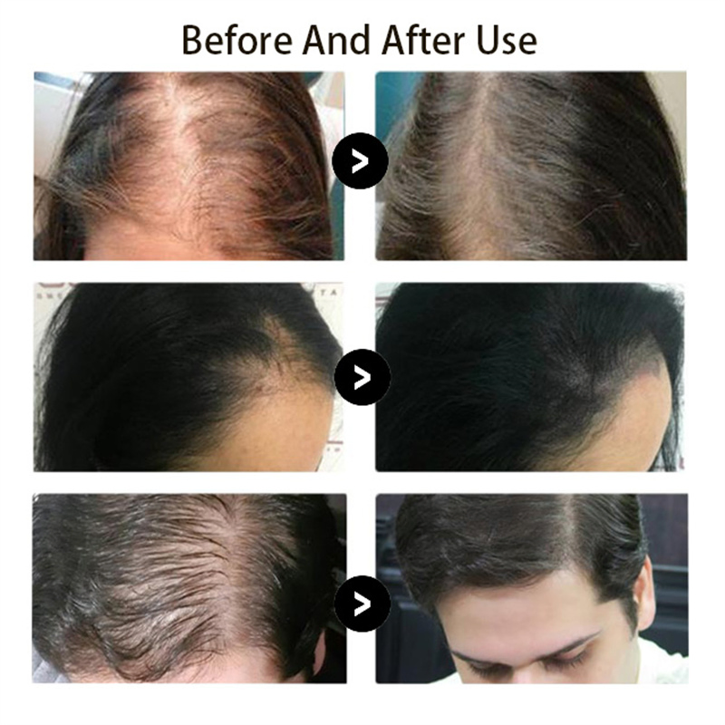 Zs 5-in-1 SPA Salon Use 650nm Diode Laser Hair Regrowth Follicle Stimulation PDT Hair Analysis Device Fast Result Anti-Hair Loss Treatment