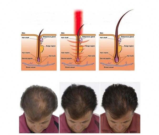 Diode Hair Growth Hatt Helmet Laser Hat Removal Machine Skin Analysis Scalp Analyzer Care Dropshipping Sample Loss Treatment