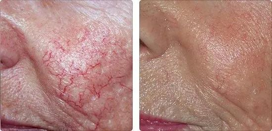 Diode Laser 980nm Forvein Removal Blood Vessels Vascular Removal Laser Device