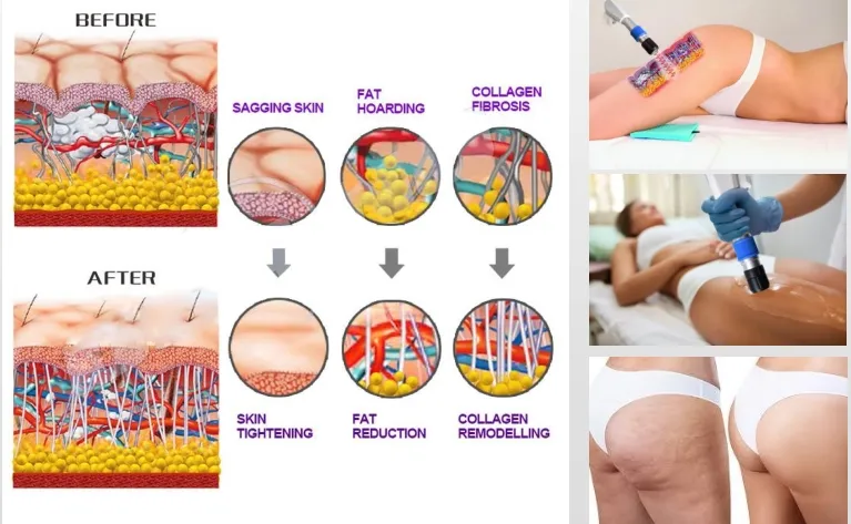 Cellulite Reduction