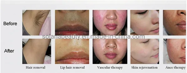 Before and After Results