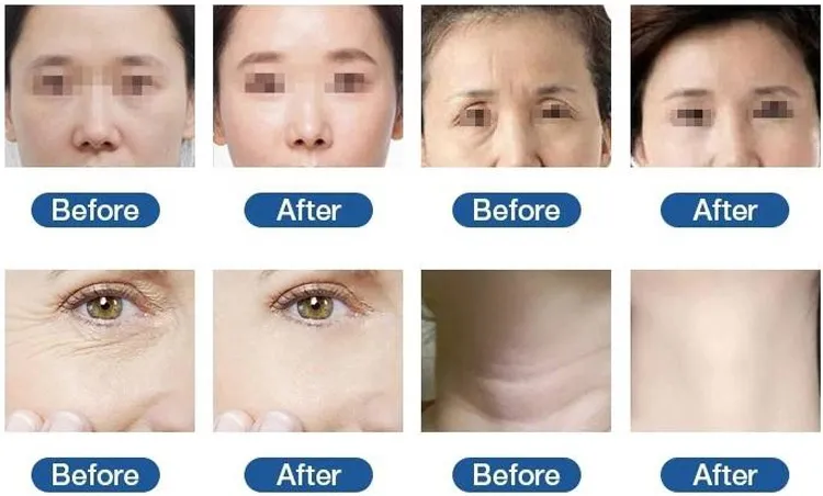 Before and After Results