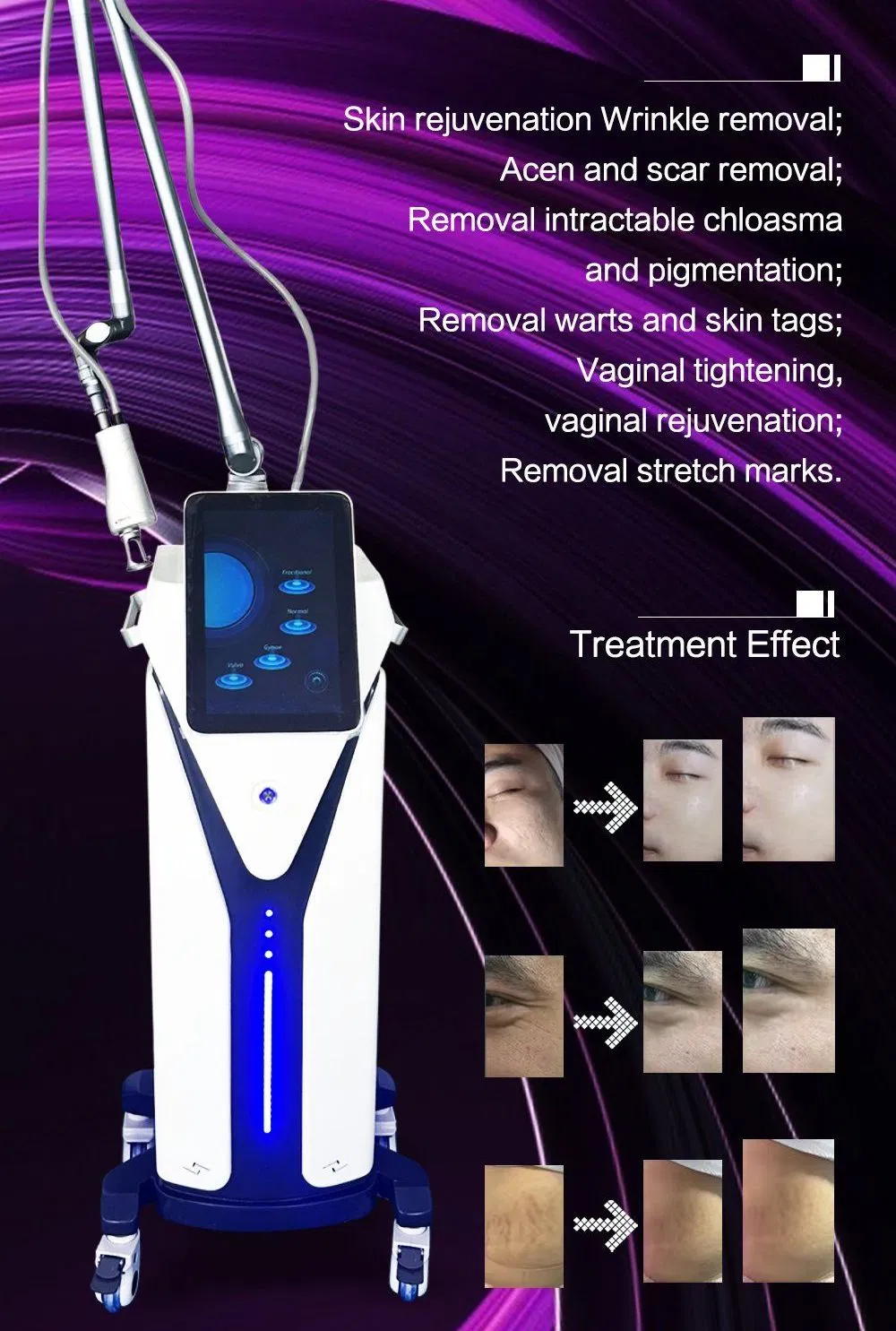 2026 FDA CO2 Fractional Laser Skin Tightening Scar and Acne Removal Skin Resurfacing Beauty Salon Laser